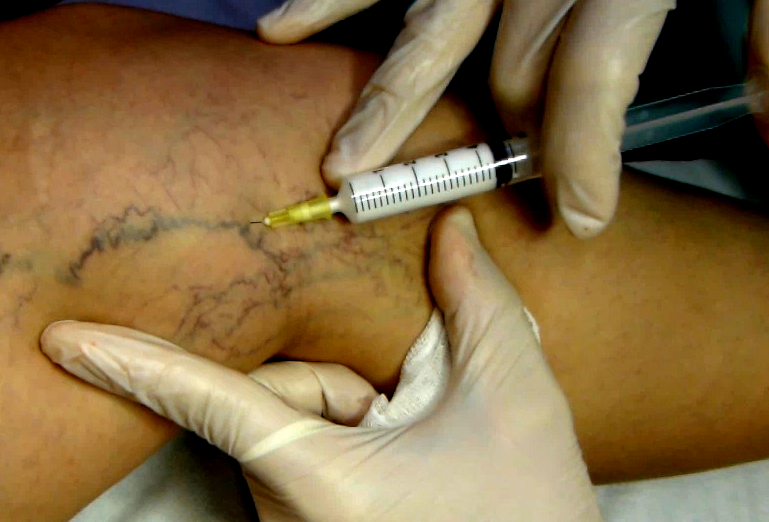 Sclerotherapy