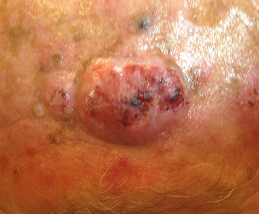 Carcinoma Espinocelular