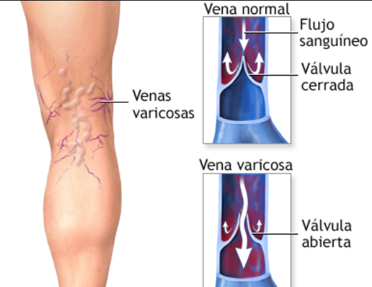 Formación de varices